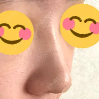 5日目の経過画像（2枚目）