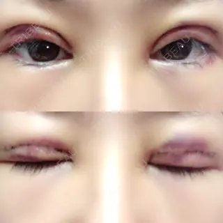 3日目の経過画像（1枚目）