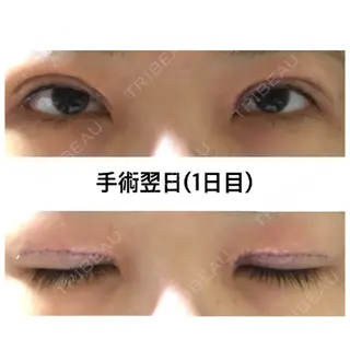 1日目の経過画像（1枚目）