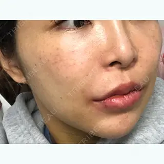 4日目の経過画像（1枚目）