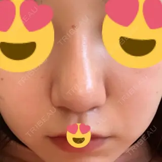 69日目の経過画像（1枚目）