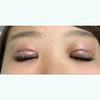 0日目の経過画像（2枚目）