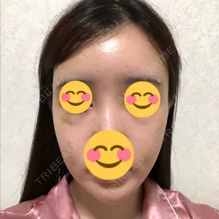 4日目の経過画像（1枚目）