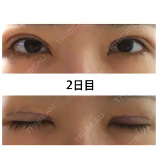 2日目の経過画像（1枚目）