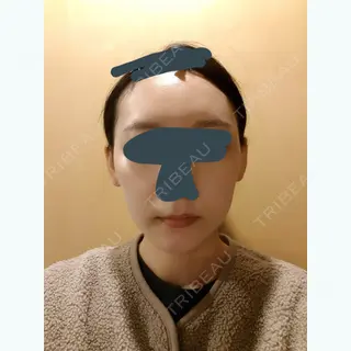 30日目の経過画像（2枚目）