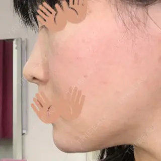 0日目の経過画像（2枚目）