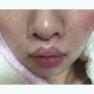 155日目の経過画像（1枚目）