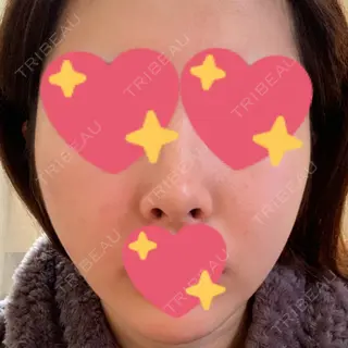 44日目の経過画像（1枚目）
