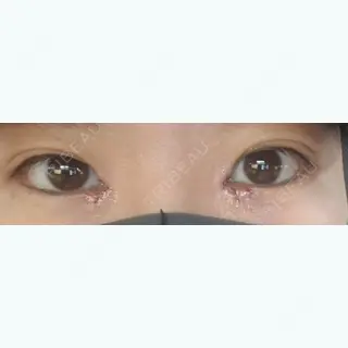 1日目の経過画像（1枚目）