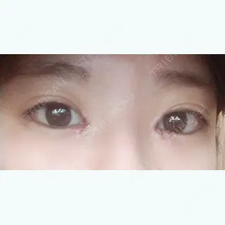 2日目の経過画像（1枚目）