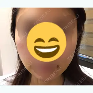 8日目の経過画像（1枚目）
