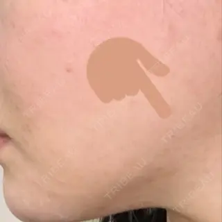 0日目の経過画像（2枚目）