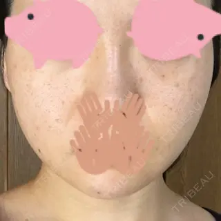 1日目の経過画像（1枚目）