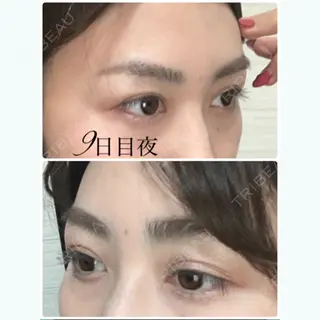8日目の経過画像（2枚目）