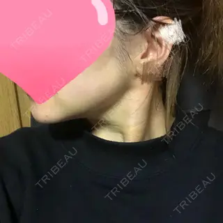5日目の経過画像（2枚目）