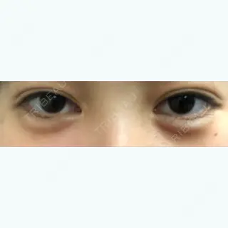 20日目の経過画像（1枚目）