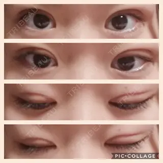 10日目の経過画像（1枚目）