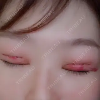 2日目の経過画像（3枚目）