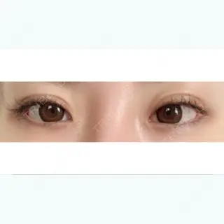 14日目の経過画像（1枚目）