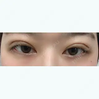 3日目の経過画像（1枚目）