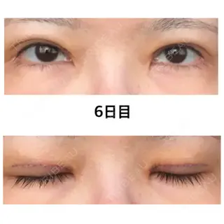 6日目の経過画像（1枚目）