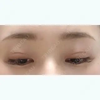26日目の経過画像（2枚目）