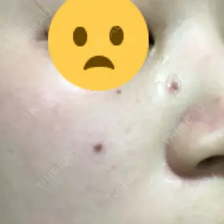 0日目の経過画像（1枚目）