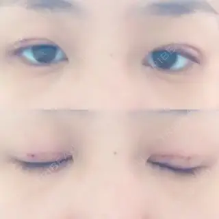 1日目の経過画像（1枚目）