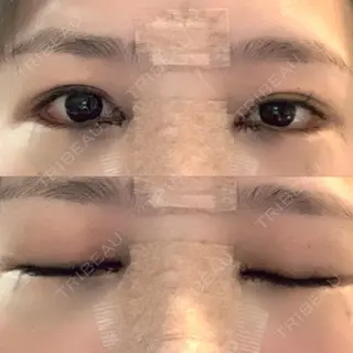 0日目の経過画像（1枚目）