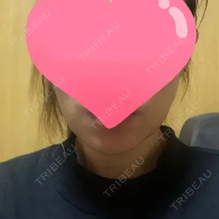 6日目の経過画像（1枚目）