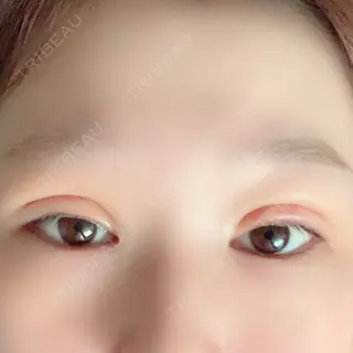 4日目の経過画像（1枚目）