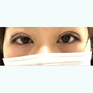 0日目の経過画像（1枚目）