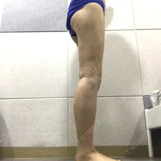 3日目の経過画像（2枚目）