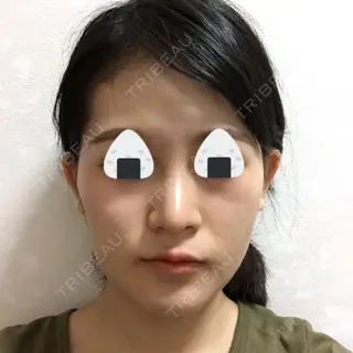 29日目の経過画像（1枚目）
