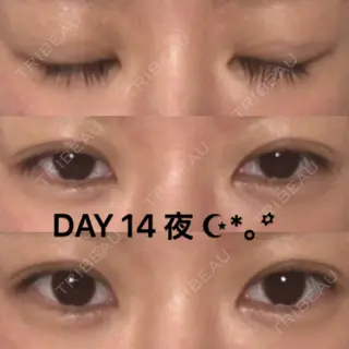 14日目の経過画像（1枚目）