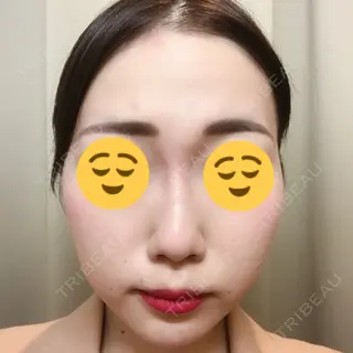 0日目の経過画像（1枚目）