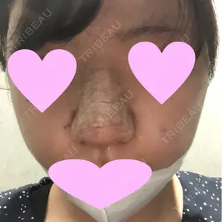 6日目の経過画像（1枚目）
