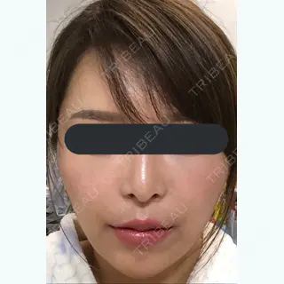 12日目の経過画像（3枚目）