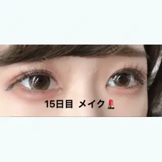 15日目の経過画像（3枚目）