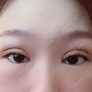 6日目の経過画像（1枚目）