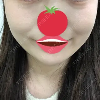 12日目の経過画像（2枚目）