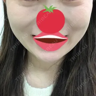 12日目の経過画像（3枚目）