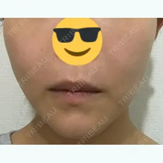 7日目の経過画像（1枚目）
