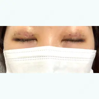 3日目の経過画像（3枚目）