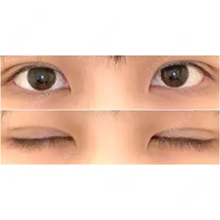 0日目の経過画像（1枚目）