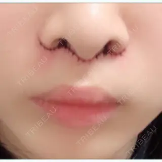 2日目の経過画像（1枚目）