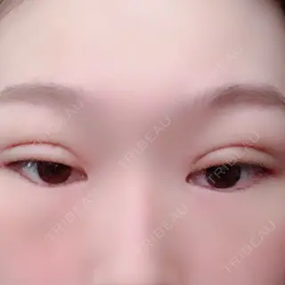 7日目の経過画像（2枚目）