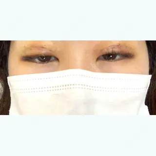 4日目の経過画像（2枚目）