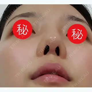 15日目の経過画像（3枚目）