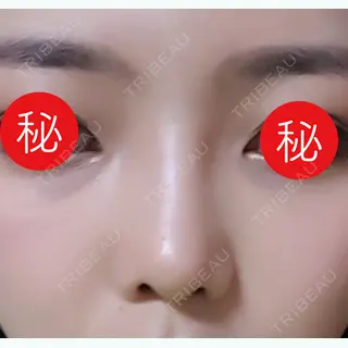 26日目の経過画像（2枚目）